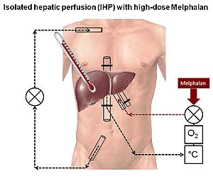 Fig. 4: Isolated hepatic perfusion (IHP) with high-dose Melphalan