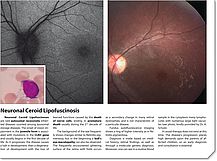 Neuronal Ceroid Lipofuscinosis