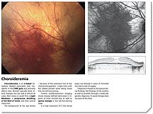 Choroideremia