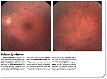 Refsum Syndrome