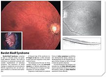 Bardet-Biedl Syndrome