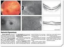 Retinitis Pigmentosa